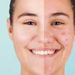Most Asked Question About Acne