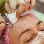 Why Holistic Acne Treatment is Better Than Modern Acne Treatment